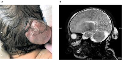 Case Report: Novel Biallelic Variants in the COL18A1 Gene in a Chinese Family With Knobloch Syndrome